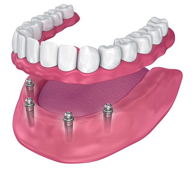Pleasant Grove All-on-4 Implants