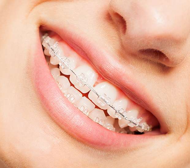 Pleasant Grove Clear Braces