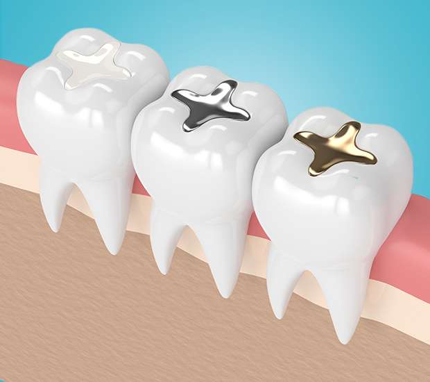 Pleasant Grove Composite Fillings