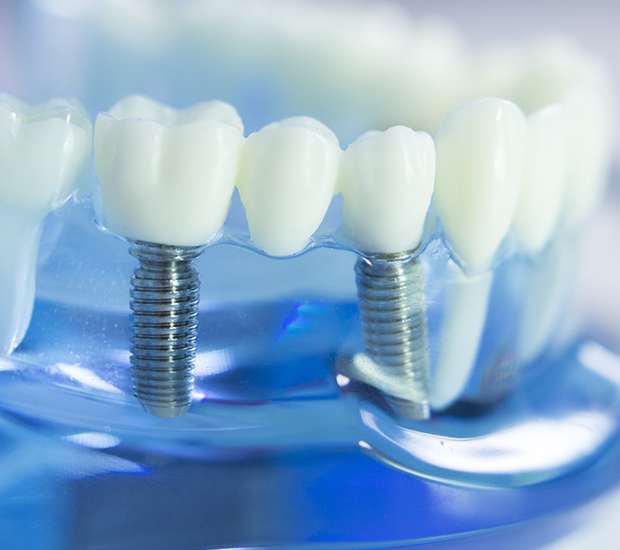 Pleasant Grove Dental Implants