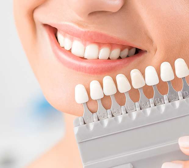 Pleasant Grove Dental Veneers and Dental Laminates
